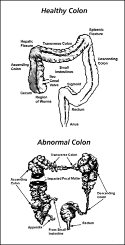 Healthy Colon vs. Unhealthy Colon